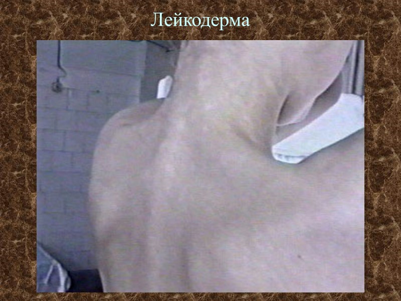 Лейкодерма